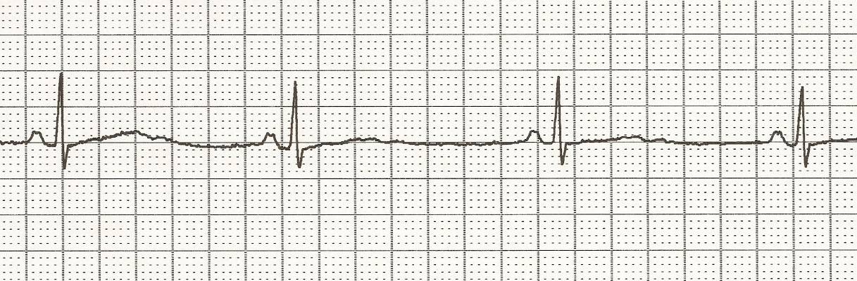 Bradycardia rhythm on an ECG strip